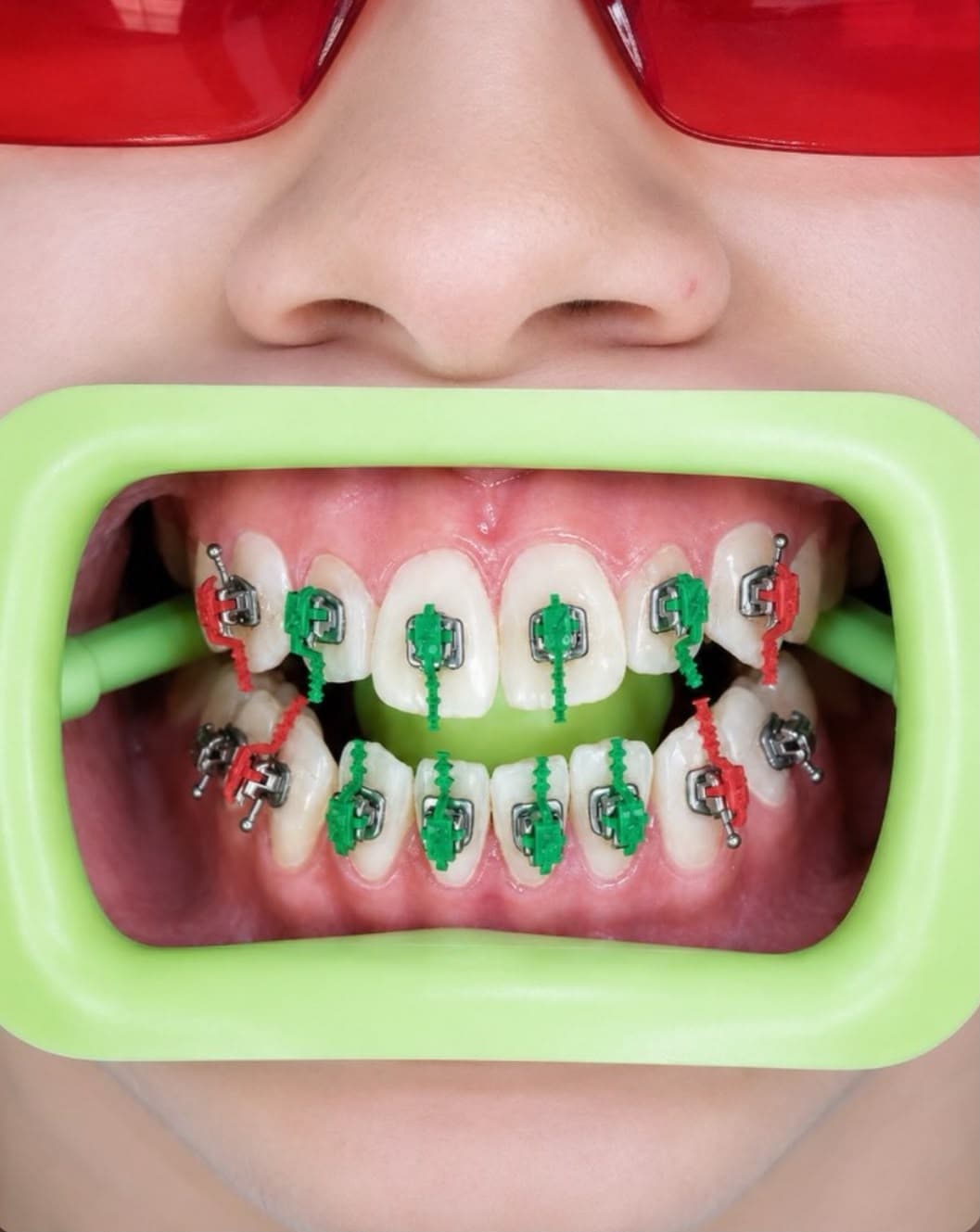 Appareil orthodontique avec bagues colorées